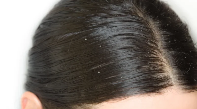 Common Causes of Dandruff