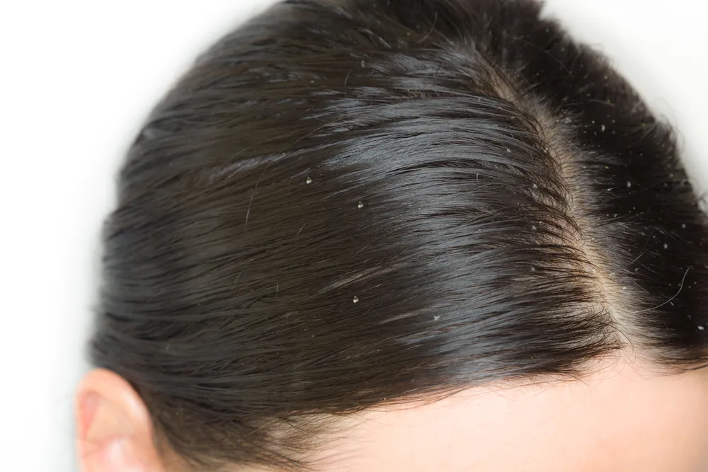 Common Causes of Dandruff