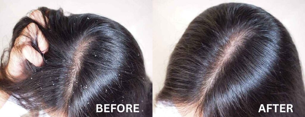 Hair Dandruff Treatment - Twacha Aesthetic Hair Treatments Clinic