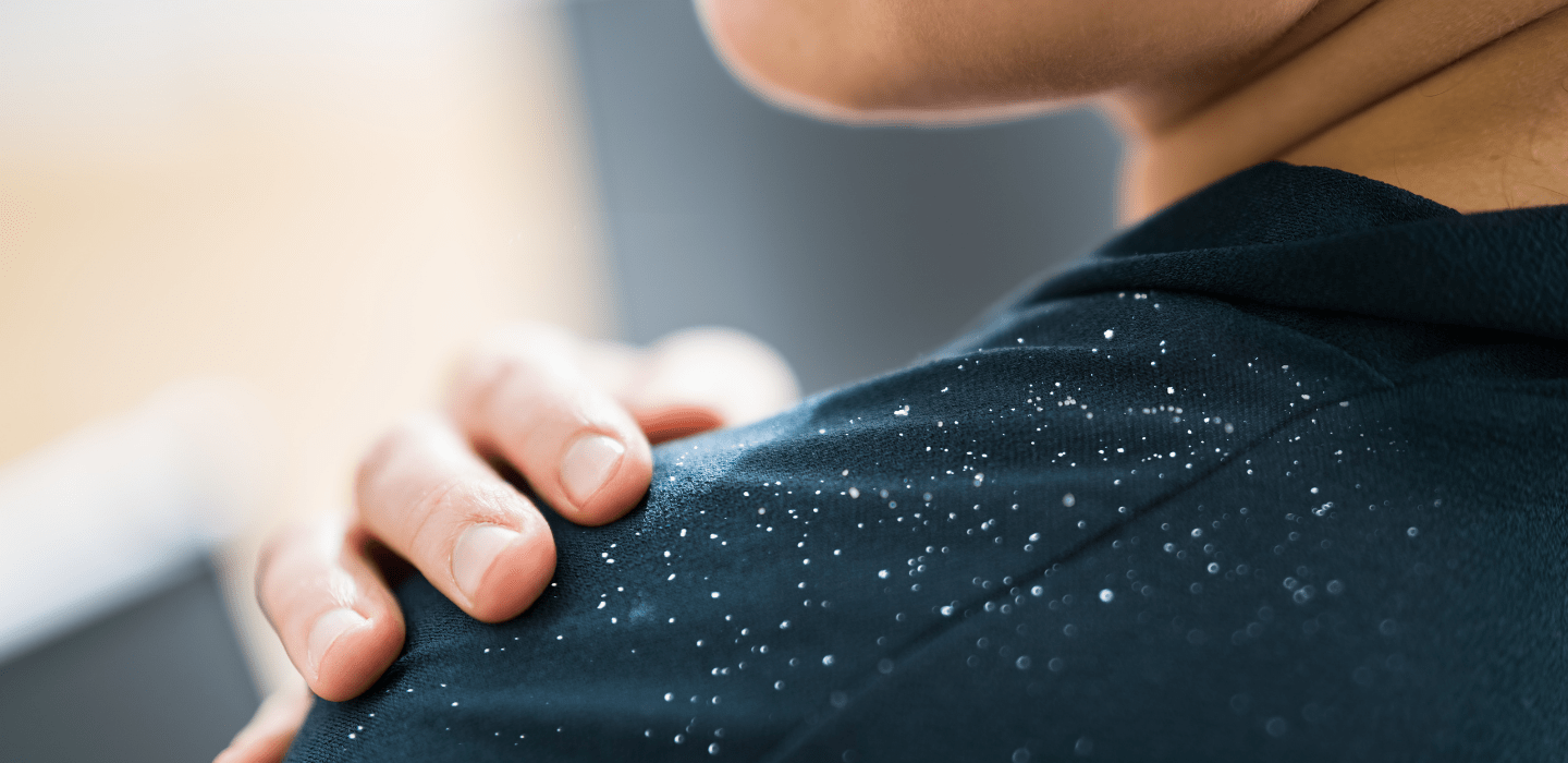 Effective Dandruff Solutions