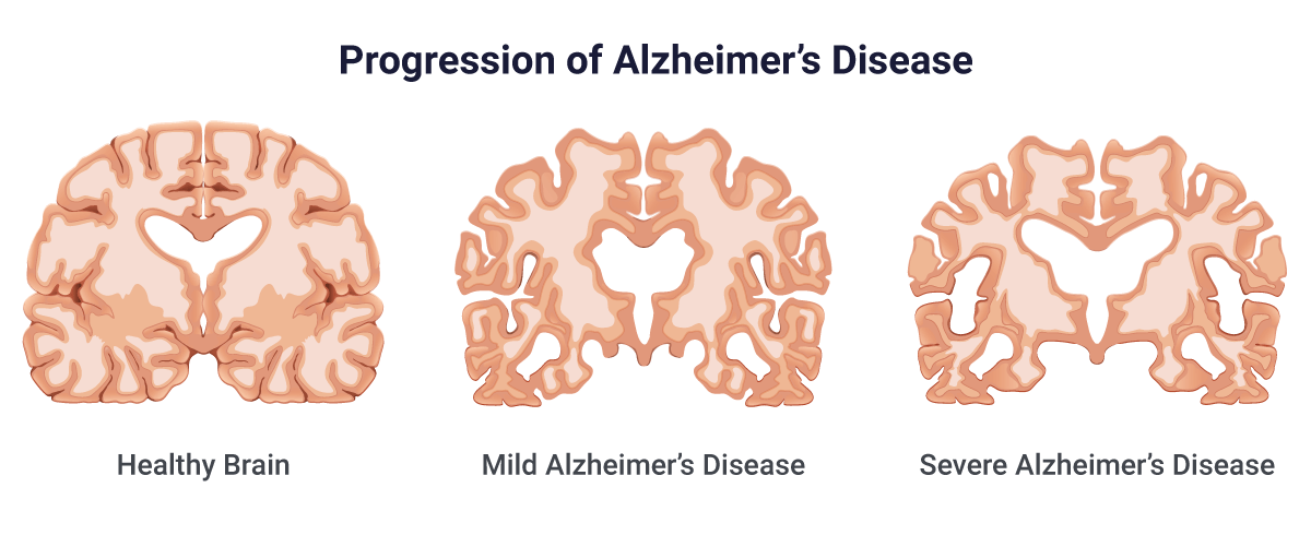 Alzheimer's