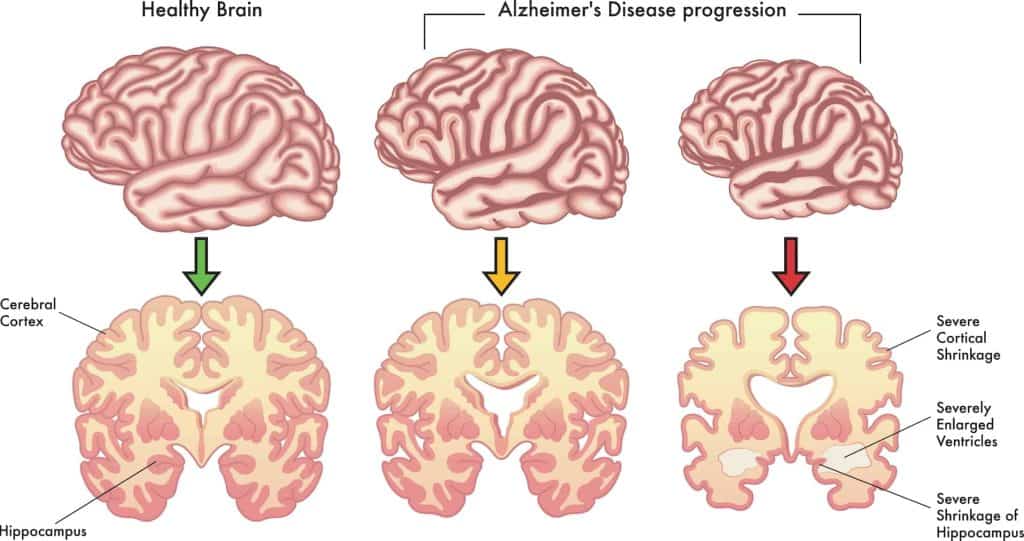Alzheimer's