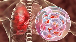 Pneumonia Akut
