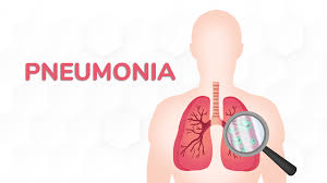 Pneumonia Akut