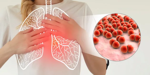 Pneumonia Akut